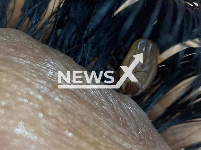 Tick found in woman's eyelashes, undated. The unusual incident occurred at eyelash specialist Maria Vitoria Araujo's salon in Vitoria, Brazil. Note: Picture is taken from local media. (Newsflash)