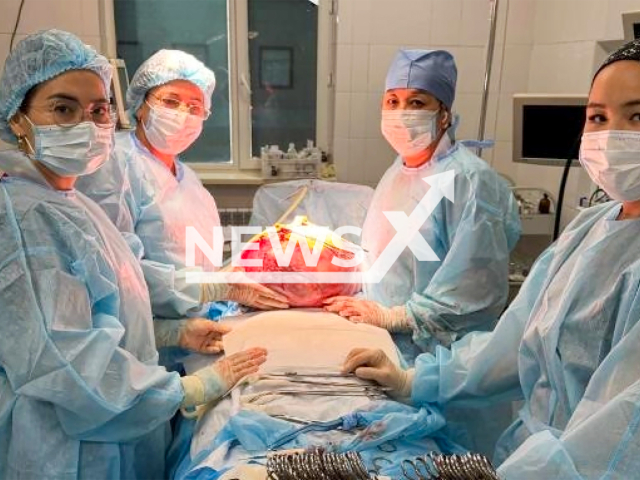 Image shows the giant 33-lb fibroid, undated photo. It was removed from a woman's uterus in Taraz, Jambyl Region, Kazakhstan. Note: Licensed content. (Ministry of Health of the Republic of Kazakhstan/NF/newsX)