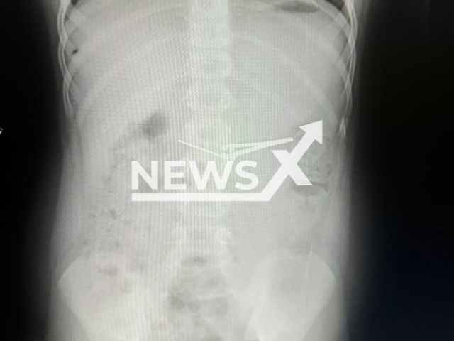 Image shows an X-ray scan of the nail clipper in the six-year-old boy's stomach, undated photo. It was removed by medics in Ufa, Bashkortostan, Russia. Note: Licensed content. (Ministry of Health of Bashkortostan/NF/newsX)