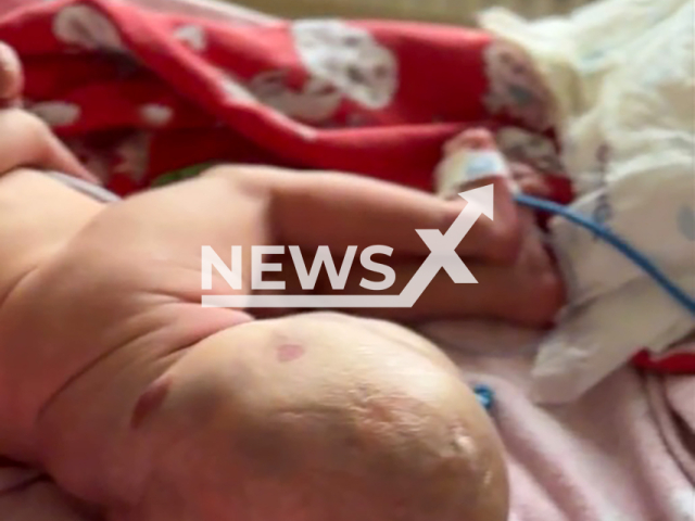 Surgeons remove one kilogram (2.2 lbs) tumor from the newborn baby on the first day of his life in the State Pediatric Emergency Medical Center in Almaty, Kazakhstan on Sunday, Oct. 6, 2024. The tumor weighed a quarter of the whole weight of the baby. Note: Photo is a screenshot from a video. (@cdnmp.kz, NF/newsX)