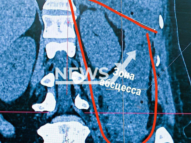 Image shows the abscess, undated photo. Medics at the Kstovo Central District Hospital, Nizhny Novgorod Oblast, Russia, opened and cleaned it. Note: Licensed content. (Kstovo Central District Hospital/NF/newsX)