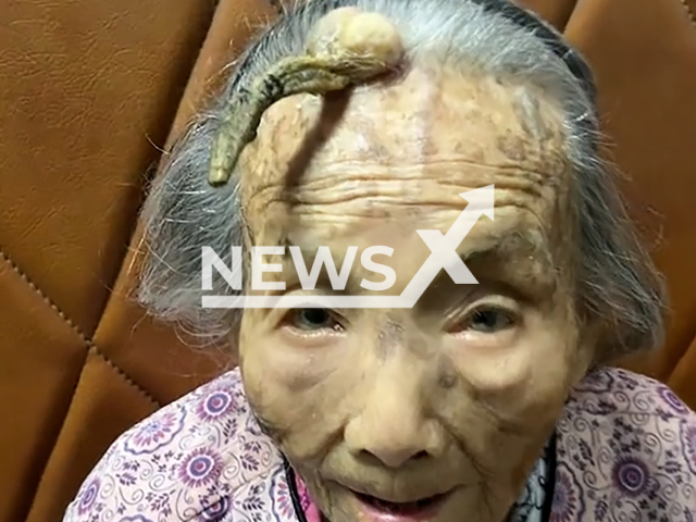 A 107-year-old grandma grows a horn on her forehead in Puning, Guangdong, China. The video was posted on Douyin the Chinese Version of Tiktok on Saturday, Oct. 26, 2024.Note: Photo is a screenshot from a video. (maXIAO78759/AWR/newsX)