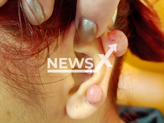 Image shows the 20-year-old woman's ear tumours, undated photo. They happened after she pierced her ears. Note: Licensed content. (Ministry Of Health Of The Moscow Region/NF/newsX)