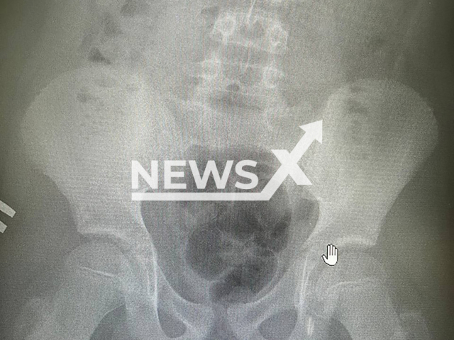 Photo shows X-ray of a boy with a needle in the urethra at the Regional Center for the Protection of Motherhood and Childhood in Lyubertsy, Moscow Oblast, Russia, undated. Doctors removed the needle without damaging the genitals. Note: Licensed photo. (Ministry Of Health Of The Moscow Region/NF/newsX)