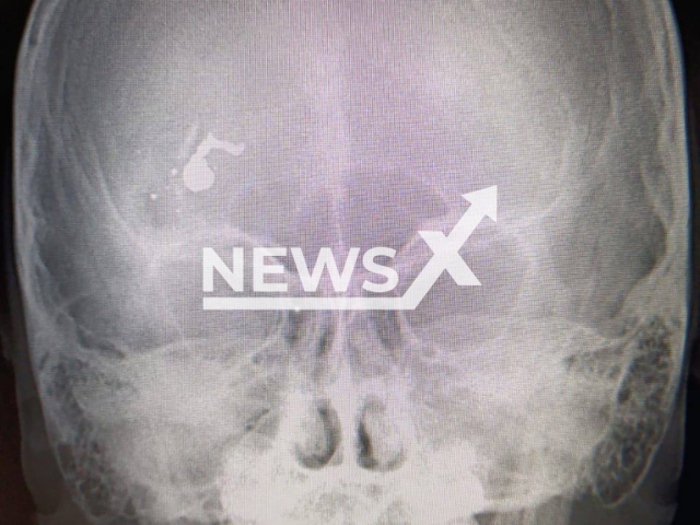 Image shows the bullet in the boy's head, undated photo. The boy sustained a head injury from an air gun in Saratov, Saratov Oblast, Russia. Note: Licensed content. (Ministry of Health of the Saratov Region/NF/newsX)