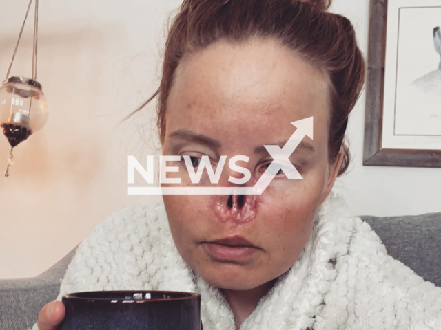 Charlotta Oskarsson, 35, poses in undated photo. Her nose was bitten off by her dog in Gallivare, Sweden. Note: Private photo taken from social media. (@charmlottan/NF/newsX)