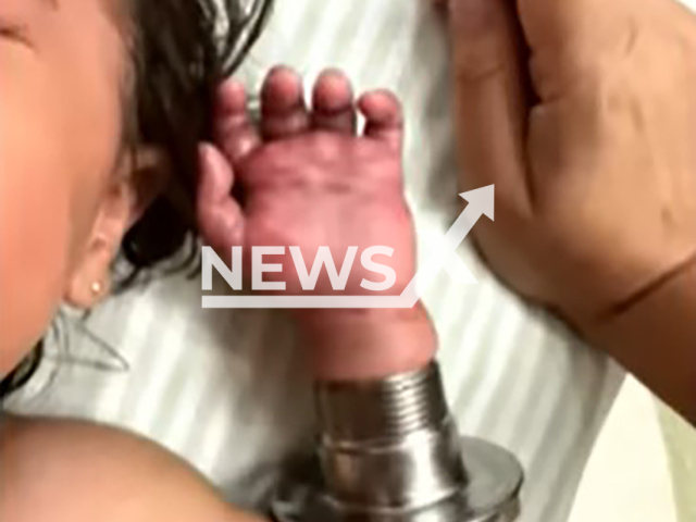 Picture shows the girl's arm, undated. Her arm was stuck in a pool in Sao Paulo, Brazil. Note: Private photo taken from local media. (NF/newsX)