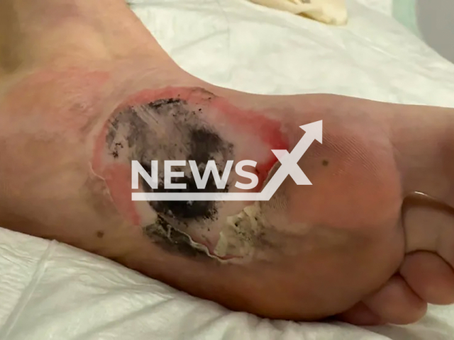 Image shows the 57-year-old man's injury, undated photo. One of the electric insoles in his mid-height Timberland shoes exploded in Muenster, North Rhine-Westphalia State, Germany. Note: Private photo from local media. (NF/newsX)