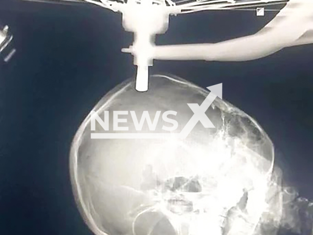 Picture shows an X-ray image of the boy's skull, undated. A 9-year-old boy had a bicycle wheel stuck to his skull after an accident in Conceicao das Alagoas, Brazil. Note: Private photo taken from local media. (NF/newsX)