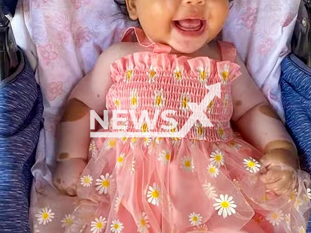 Picture shows baby Olivia, undated. She was born with a condition known as piebaldism in Maranhao, Brazil. Note: Private photo taken from local media. (Newsflash/NX)