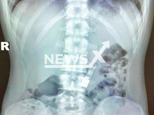 Picture shows an X-ray of the boy's stomach in Moscow, Russia, undated. He swallowed a flash drive containing his homework. Note: Licensed photo taken from the Ministry of Health of the Moscow Region. (Ministry of Health of the Moscow Region/Newsflash/NX)