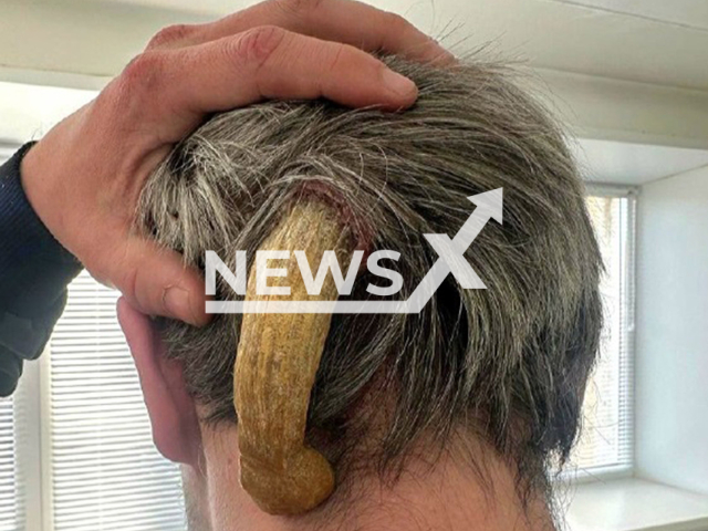Picture shows the "devil's horn", undated. The horn was removed from Naberezhnye Chelny resident in Russia. Note: Hospital photo. (@bolnica5_chelny/Newsflash/NX)