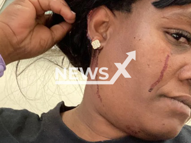 Picture shows injured Aqeela Benjamin, undated. They were robbed in Browns Farm, Philippi, South Africa. Note: Private photo taken from local media. (Newsflash/NX)