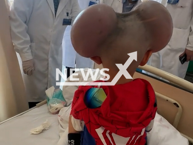 Video shows the three-year-old boy who was teased for looking like Mickey Mouse, undated. He underwent two surgeries in Shanghai, China. Note: Photo is a screenshot from a video. (AsiaWire/NX)