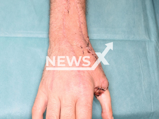 Picture shows the man's finger after surgery, undated. A toe has became a thumb at the Feldkirch Specialist Hospital in Austria. Note: Hospital photo. (VLKH/Newsflash/NX)
