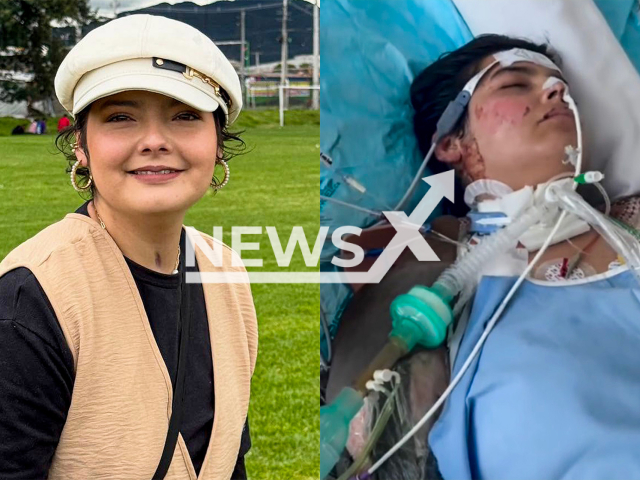Photo shows Laura Villamil after recovery on the left and on the right in hospital, undated. She suffered severe burns over 90 percent of her body while performing at the well-known Andres Carne de Res restaurant in Chia, Cundinamarca in Colombia. Note: Private photo taken from social media. (@lauradvillamilactriz/Newsflash/NX)