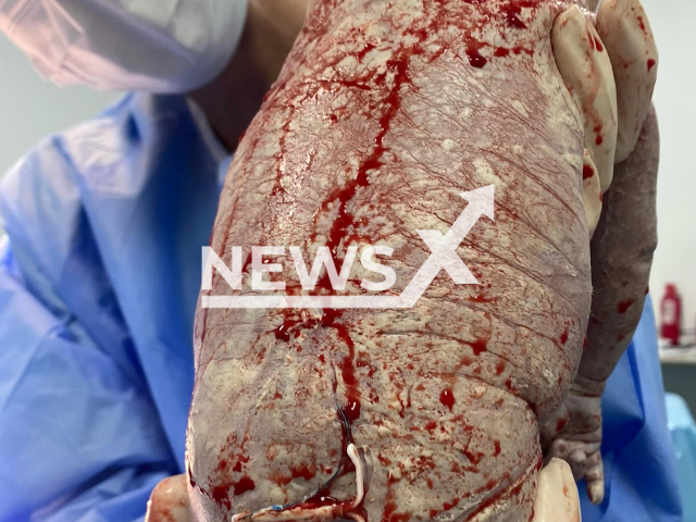Picture shows baby born with mother's IUD in Brasilia, Brazil, May 4, 2025. According to the doctor the device was not piercing the baby's skin. Note: Private photo taken from social media. (@drarafaelafrota/Newsflash/NX)