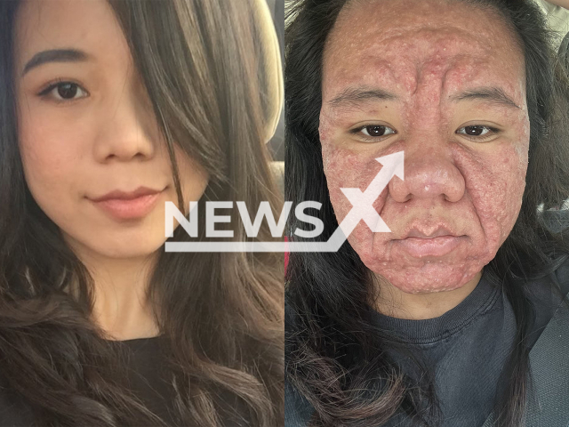 Picture shows the Malaysian woman before (left) and after (right) the change she experienced during pregnancy, undated. Note: Private photo taken from social media. (@ayyitslala/Newsflash/NX)