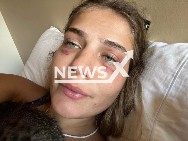 Jannah Nebbeling shows signs of the alleged assault, undated. She accuses former Paraguayan player of assault and imprisonment in Paraguay. Note: Private photo taken from social media. (@_fadabless/Newsflash/NX)