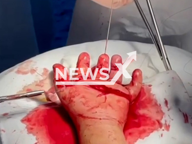 This image is a screen grab of the video supplied titled NewsX-GirlGrinder-01.mp4: Footage shows doctors provided assistance at the Children's Republican Clinical Hospital to a three-year-old girl who crushed her fingers with a meat grinder in Ingushetia, Russia on Wednesday, Aug 6, 2025.(Clipzilla/NX)