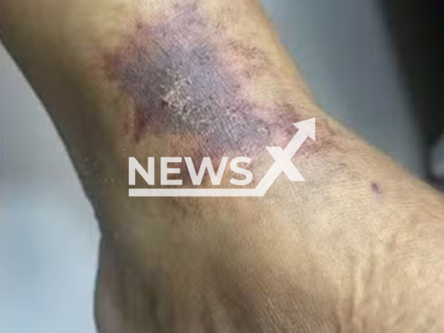 Photo shows sustained wounds on the leg from the electrical cable in Pina, Recife, Brazil on Thursday, Aug 21, 2025.
Note: Private photo.
(Clipzilla/NX)