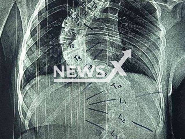 Photo shows the spine of a 13-year-old girl before operation to fix deformity in Russian-occupied Zaporizhia region, undated. The Ministry of Health of Russia published the case on 1 September, 2025. Note: Licensed photo. (Ministry of Health of Russia/Newsflash/NX)