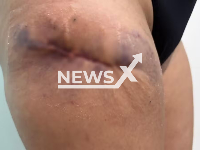 Picture shows the injuries on Karim Kamada's body, undated. She said they appeared after undergoing an enzyme-based cosmetic procedure in Jaragua do Sul, Brazil. Note: Private photo. (Newsflash/NX)