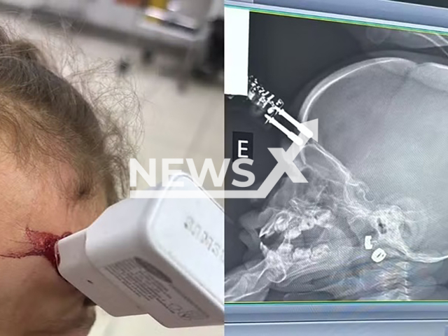Picture shows the injury on the child (left) and an X-ray image of the injury (right), undated. A one-year-old girl ended up with charger embedded in her forehead after falling out of bed in Divinopolis, Brazil. Note: Private photo. (Bruno Castro/Newsflash)