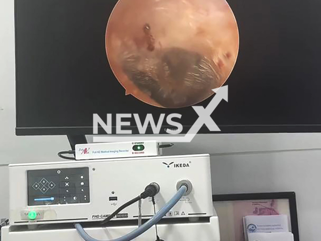 Ant enters Russian woman's ear in Thailand, undated. Doctors removed the insect. Note: Photo is a screenshot from a video. (Elena Meshcheryakova/Newsflash)