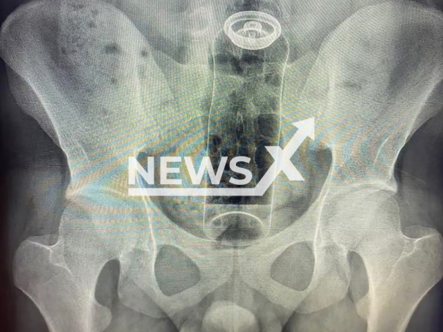 An x-ray image shows the deodorant stuffed in the bum, undated. A 19-year-old patient had inserted the item during a sexual game. Note: Private photo. (Newsflash)