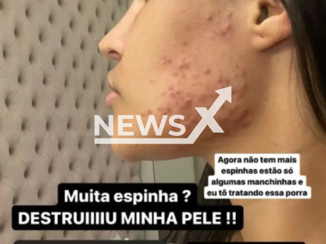 Brazilian singer Flay showing her face full of pimples after using the beauty chip.
Note: Photo is a screenshot from Instagram post(@flay/Newsflash).