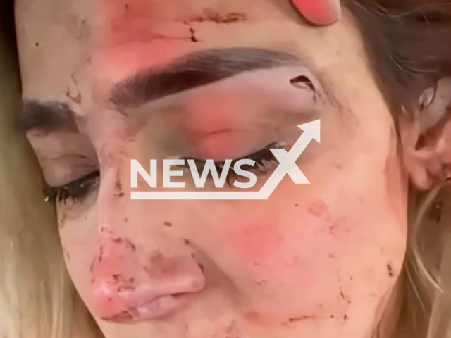 TV host Edna Monroy shows her injuries after being attacked by her ex-partner in Mexico, undated. According to the information she made public, the events occurred on September 6, 2025. Note: Photo is a screenshot from a video. (@ednamonroy/Newsflash)