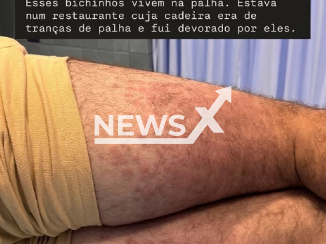 Actor Lucas Malvacini, 36, shows how his legs look after mite bites in Bali, Indonesia, undated. He was hospitalized. Note: Private photo taken from social meda. (@lucasmalvacini/Newsflash)