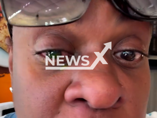 Video shows Cacau Protasio's eye, undated. She lost her sight due to a hair pomade. Note: Photo is a screenshot from a video. (@cacauprotasiooficial/Newsflash)