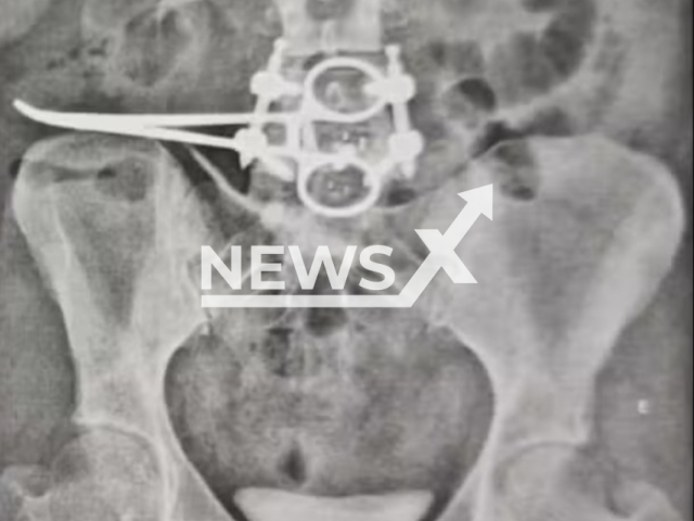 Picture shows the surgical scissors left in the patients abdomen after surgery. Erica Cristina Bannai Von Hoonholtz had a hysterectomy and found that approximately 18 centimeters long  scissors had been left inside her abdomen during the surgery. Note: Private picture. (Newsflash/NX)
