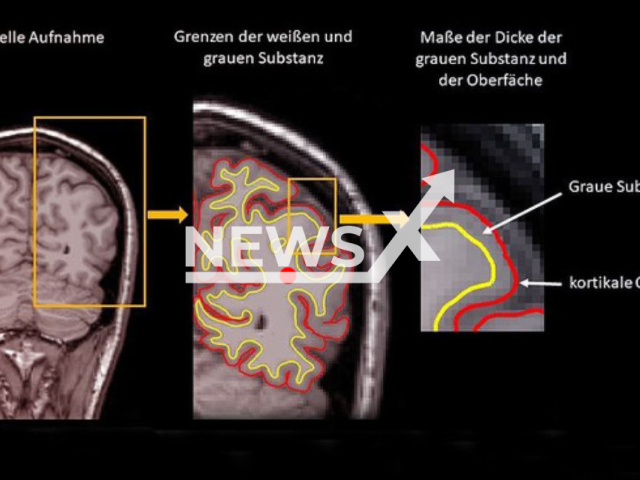 Changes in the brain caused by early childhood experiences are not entirely irreversible.
Note: Licensed photo(UHH/Newsflash).