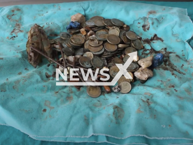 Tens of coins, batteries, magnets, nails, glass pieces, stones and screws were removed from the stomach of a 35-year-old patient who was admitted to the hospital with the complaint of abdominal pain in Van, Turkey. Note: Picture is a screenshot from a video (Newsflash)