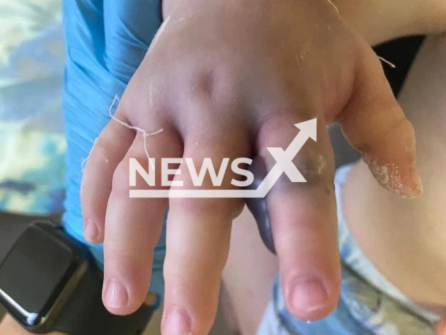 The hand of a one-year-old baby who was bitten by a snake turned black and got swollen in Kemerovo, Russia. Note: Photo is from the Ministry of Health of Kuzbass (Ministry of Health of Kuzbass/Newsflash)