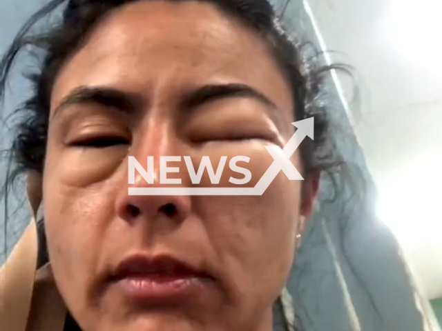 Student Amanda Souza Oliveira Nicandio, 22, after she was left practically unrecognizable when she had a shrimp allergy during a trip to Rio de Janeiro, Brazil. Note: Picture is a screenshot from a video (@amandanicandio/Newsflash)