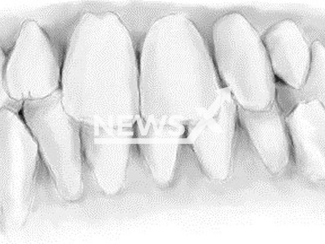 An image of the teeth of the unidentified dead woman found on Wednesday on 15th June, whose identity the German police are trying to discover. Note: Licensed photo. (Polizeiprasidium Mainz/Newsflash)