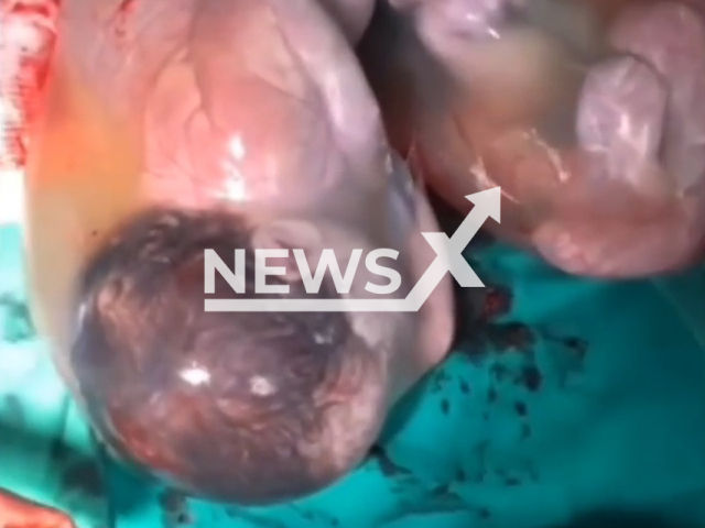 Twins born in amniotic sack in Minas Gerais in Brazil. Note: Picture is a screenshot from a video (Hospital de Nossa Senhora das Dores/Newsflash)