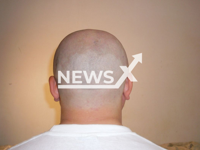 The back of the head of a male with no hair, in an undated photo. New research into factors that control the life and death of hair follicle cells could help people with baldness, as well as wound healing, according to researchers from the University of California, Riverside in CA, USA. Note: Licensed picture (Helpaeatcontu/Newsflash)