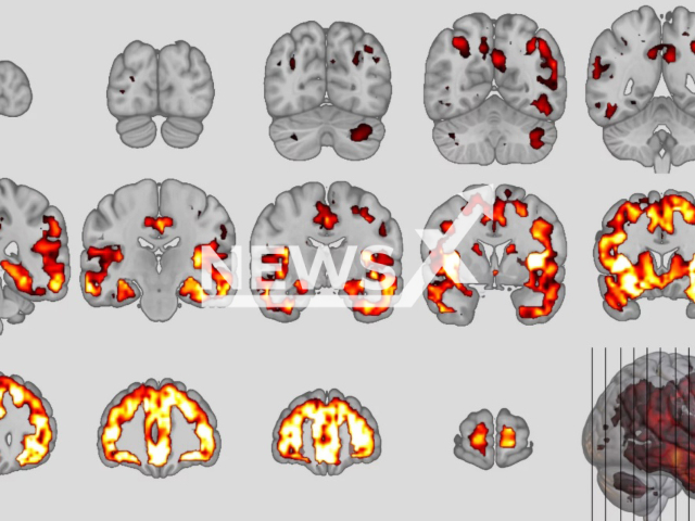 Illustration shows neuroanatomical patterns of the behavioral variant of frontotemporal dementia in an undated photo. Researchers from the Max Planck Institute for Human Cognitive and Brain Sciences discovered similarities between schizophrenia and dementia as reported on Aug. 4, 2022. Note: Licensed content. (Nikos Koutsouleris/Newsflash)