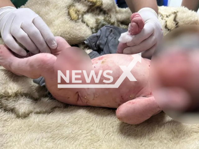 The newborn baby girl who was found abandoned in a garbage bag being examined at the Itapuranga Hospital in Itapuranga , in the central region of Goias, Brazil, on Thursday, Sept. 8, 2022. Local police who are investigating the case reported that the woman who claimed to have found the baby is actually her mother. Note: Police photo (Goias Military Police/Newsflash)