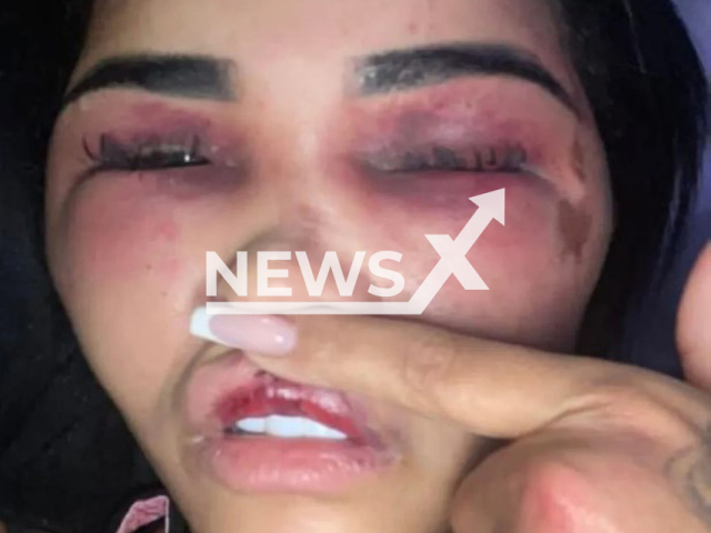 Picture shows Thamires da Silveira Sales' swollen face, undated. Silveira was allegedly beaten up by her ex-husband in the West Zone of Rio de Janeiro, Brazil, on Monday, Sept. 5, 2022. Note: Private photo (Newsflash)