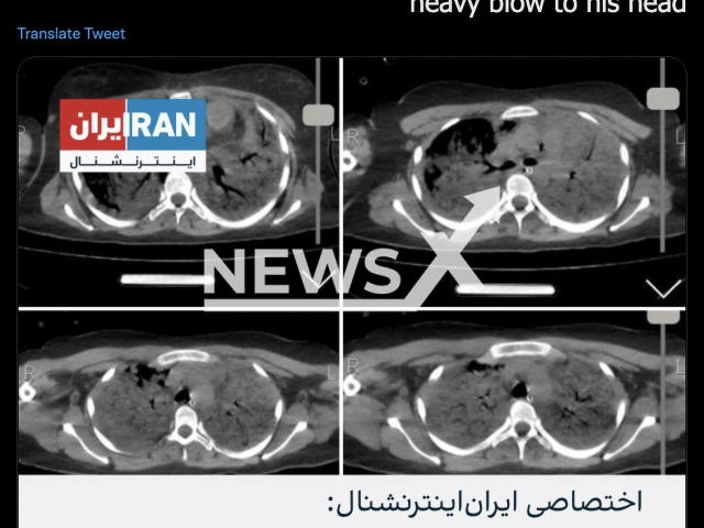 Photo shows the CT scan of Mahsa Amini, undated photo. Mahsa Amini, a 22-year-old Kurdish woman, died in hospital Friday, Sept. 16, 2022, three days after she was arrested and reportedly beaten by morality police in Tehran, Iran. Note: Picture is a screenshot from a post (Newsflash)