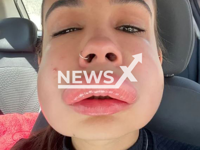 Picture shows  Oliveira Almeida Pinheiro, 20, during an allergic reaction  in Palmeiras, Brazil, on Sept. 1, 2022. This occurred when correcting lip filler, she was taken to a hospital and her face returned to normal about four days later.      Note: Private photo.  (Newsflash)