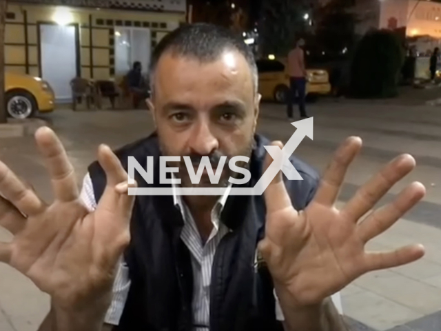 Photo shows the hands of Bilal Dag, who has 11 fingers, undated photo. Dag, who lives in Elazig, Turkey, states that his two children also have more than ten fingers on their hands. Note: Picture is a screenshot from a video (Newsflash)