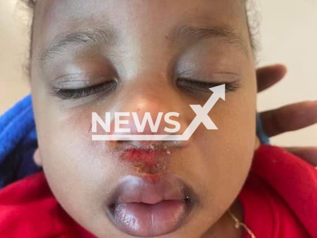 The injuries caused to 1-year-old Cylen, one of the children of Corey Joseph Marioneaux Jr., 24,  that were taken  in police custody when  Police SWAT officers, arrested the father, in Pensacola, Florida, USA, on 3rd February. 
Note: Private photo.  (Newsflash)