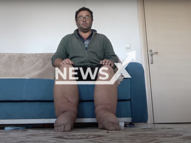 Tuncer Demirezen poses in an undated photo. Demirezen, who lives in Sarkisla, Sivas, Turkey, has a disease called 'Lymphatic filariasis' and developed a syndrome called 'elephantiasis', which is marked by severe swelling in the legs. Note: Picture is a screenshot from a video (Newsflash)